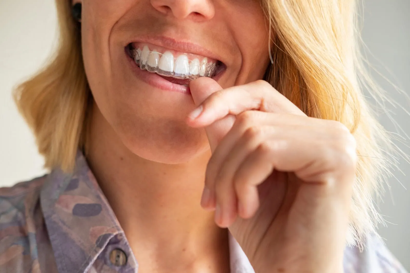 Invisalign clear aligners close-up