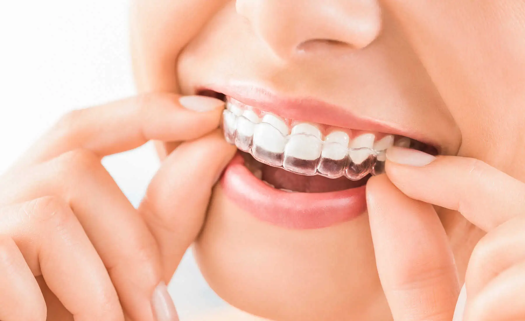 Invisalign clear aligner tray