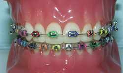 metal braces