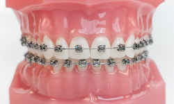 self-ligating braces